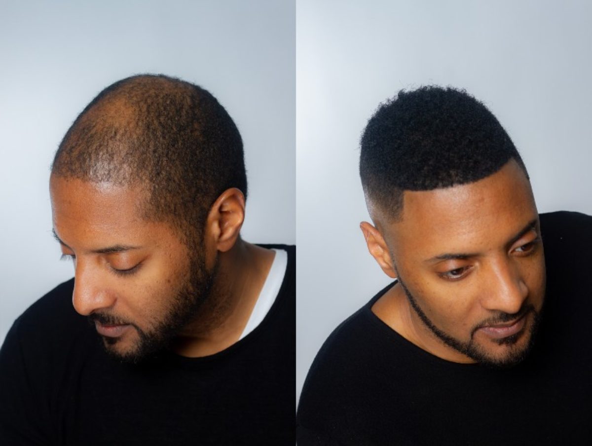 Male Non Surgical Hair Replacement