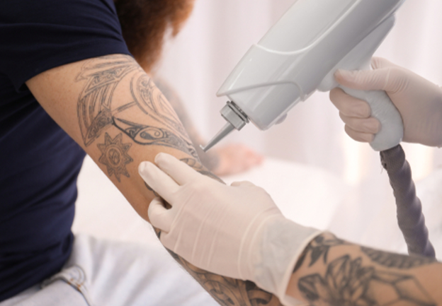 laser tattoo removal birmingham