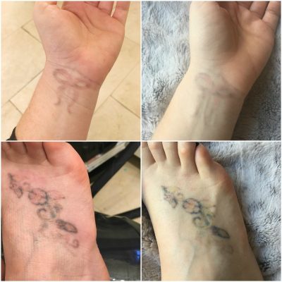 tattoo-removal-collage-6th-session